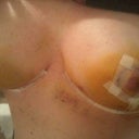 Day 6 post op