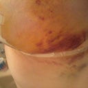 Day 6 post op - Left side again