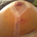 Day 6 post op - Underneath right breast