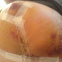 Day 6 post op - Underneath left breast