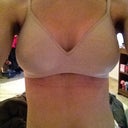 You can see the bruising underneath where the surgical bra had TIGHTLY adhered to my skin. Hope it vanishes away quickly in time!