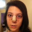 This is the day of the surgery. I took this picture right before I was going to change my bloodcatching cloth under my nose. So far so good.