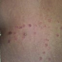 laser burns