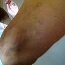 Brusing on the back of leg