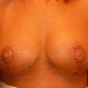 See how they are not the nipples are not the same.  One areola is mound shaped, nipple erect, the other is areloa is flat,nipple flat and not centered.