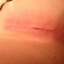Left incision at 2wks