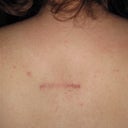 about 3 months post-op