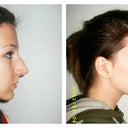 Left side: before....Right side: about 3 weeks post op