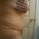 Side view 11 days post op.