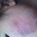 skin bern on right side