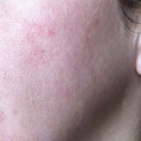 One year after Fraxel.  I have orange peel with underlying cottage cheese look, hyper and hypo pigmentation, broken caps with overal redness, and weird lines.