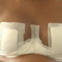 5 days after surgery
