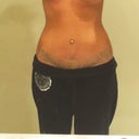 3 weeks post op