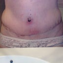 Here's the nasty redness / infection