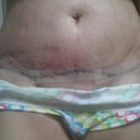 Post op day 3, insision