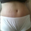 Post op day 4