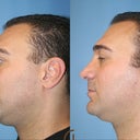 Male Rhinoplasty