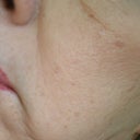 After surgery?  Looks the same as before.