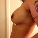 9-3-12 3rd full day of recovery. Softer and swelling going down in my abdomen some.
