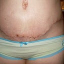 Incision line- 3 weeks PO
