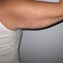 Pre-op back view