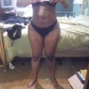 seroma on right side
