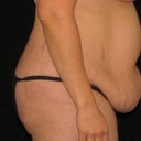 Thought this was all fat,  Exercising was always interesting with this flap in the way.