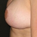 Seven weeks - Post Op
Side view