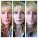 My nose is still very swollen. Before, 10 days, 20 days...and counting
