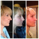 My long nose was not sophisticated after all. Before, 10days, 20 days...