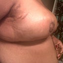 Anyone else have side armpit jowls? The big swollen flaps under my arms are way strange.