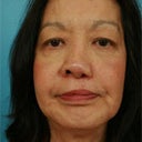 Female Treated For Adult Cleft Palate