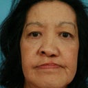 Female Treated For Adult Cleft Palate
