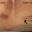 left and right side 1 month PO. backward I know :)
see that bit of hangy skin on the right side...dogear maybe?