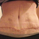 scar 1 month PO. bruises almost gone yay!