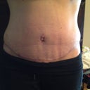 4.5 weeks post op....my scar is healing nicely but still swollen over my scar