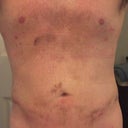 3 day post. A little more bruising and some swelling around belly button.