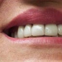 the right tooth is little crocked its a veneer crown