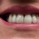 when smile big you can see spaces between