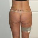 1-week post op