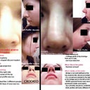 My Rhinoplasties at a glance. 
