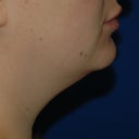 Side profile, prior to procedure.