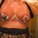 1 DAY POST OP