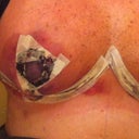 1 DAY POST OP