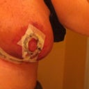 1 DAY POST OP