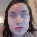 1 month 2 days, skin is not bad but not perfectly clear. Overall I'm happy that it doesn't look too terrible and red marks are fading!
