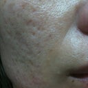 before pic of the left