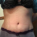 the lines are from my garment i havent been able to give it up yet. makes me feel secure. 9weeks po and 2 weeks po revision
