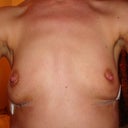 1 week after capsulectomy