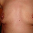 6 weeks post op